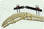 Monolateral Wrist Fixator