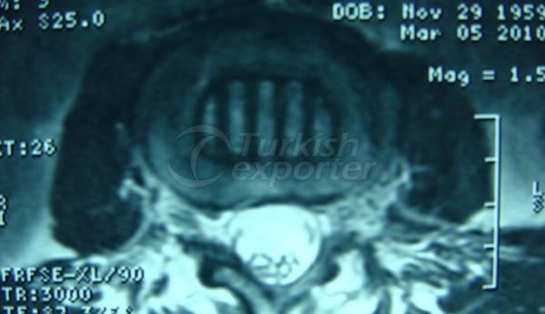 Interbody Fusion System