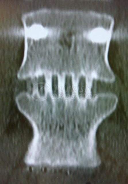 Interbody Fusion System