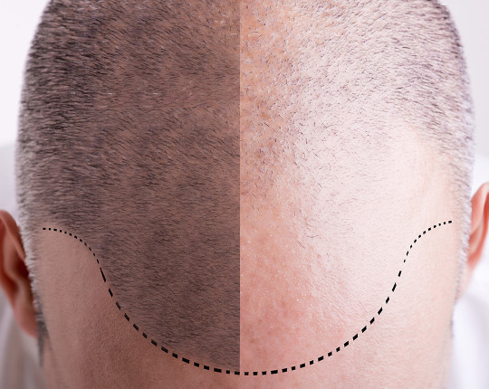 Hair Transplantation